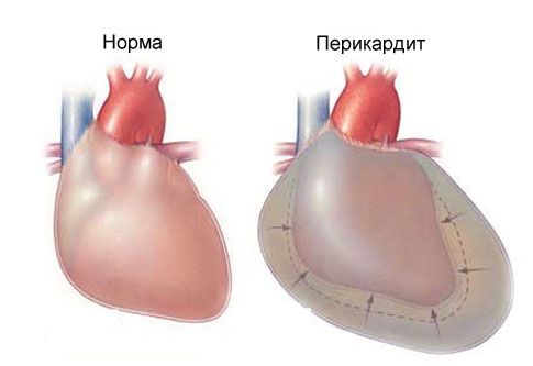 Akūts perikardīts un sāpes krūtīs pa kreisi