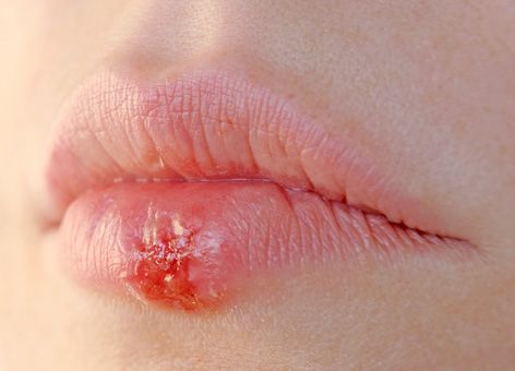 Kāpēc herpes "uznirst"?