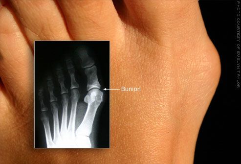 Lielā pirksta buniona vulgus deformācija