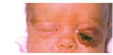 Apakšējā plakstiņa hemangioma.