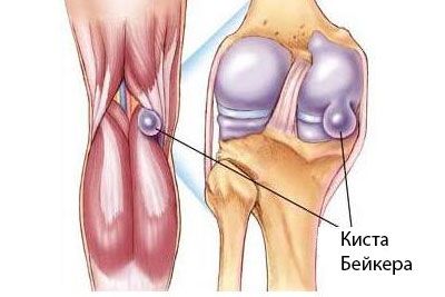 Beikera cista