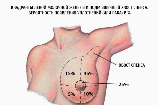 Kreisā krūšu kvadranti un Spences padušu aste. Veidojumu (vai vēža) attīstības varbūtība procentos.