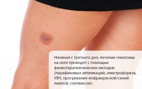 Hematomas ārstēšana uz kājas