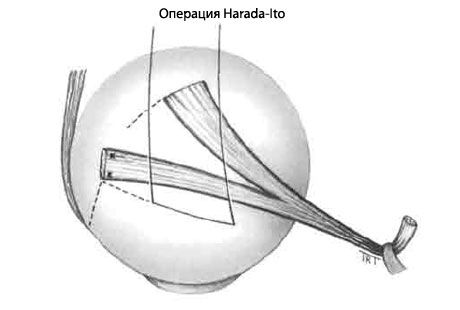 Šķielēšana - operācija