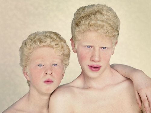 Albīnisms