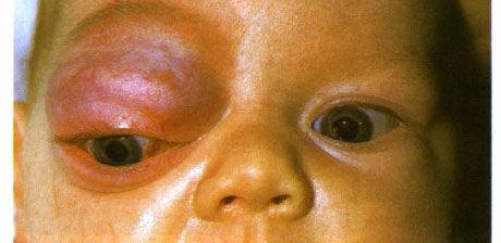 Priekšējās orbītas un augšējā plakstiņa kapilārā hemangioma. Neoplazmai ir tendence progresēt