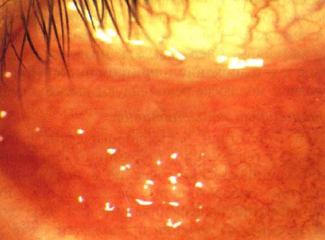 Akūts folikulārs konjunktivīts bērnam ar vairākiem molluscum contagiosum bojājumiem