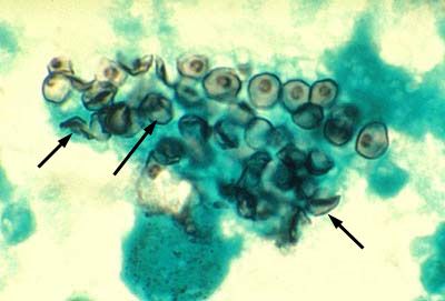 Pneimocistozes izraisītājs (Pneumocystis jiroveci)