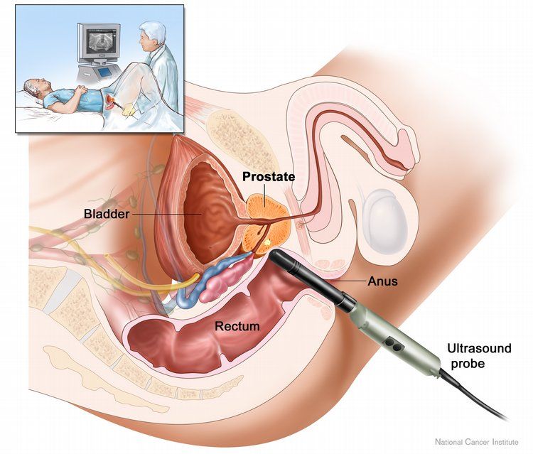 Pamatojoties uz tēju un zeltu, ir izveidotas efektīvas zāles pret prostatas vēzi