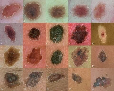 Zinātnieki ir atraduši gēnu, kam ir galvenā loma melanomas attīstībā