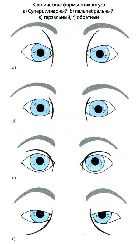 Epikantusa klīniskās formas.  a) cīpslas, b) palpebral, c) tarsal, d) reverss